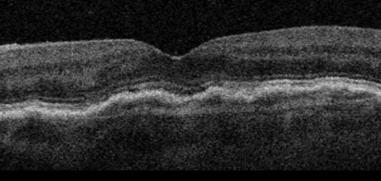 Kuiva silmänpohjan ikärappeuma
