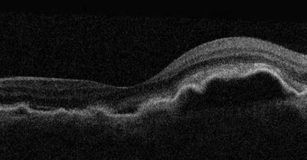 Nestekertymää silmänpohjan verkkokalvokerrosten alla