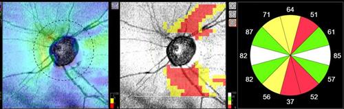 Glaukoomaa pystytään havaitsemaan esimerkiksi näköhermonpään OCT-kuvauksella